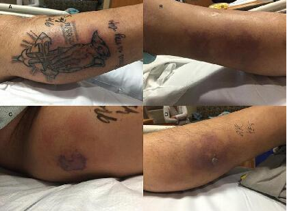 纹身后下水,竟导致全身溃烂,最终抢救无效不治身亡
