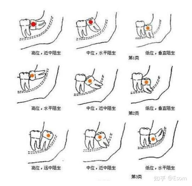 请问一下大家我这种智齿难拔吗