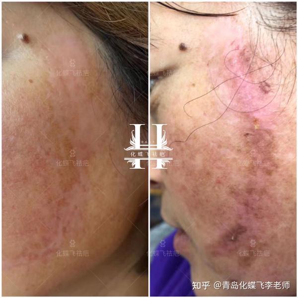 贵州贵阳,药水点斑,腐蚀了皮肤,产生的疤痕就像被硫酸泼了一样,基本上