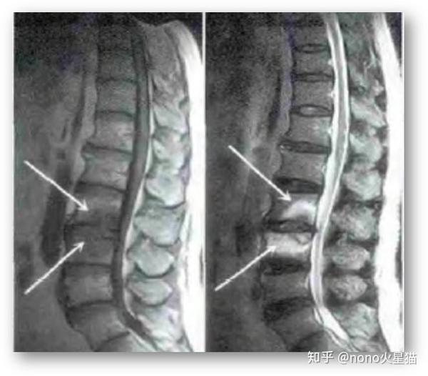 腰2,3 椎体呈骨质破坏,椎间隙未见明显变窄,椎间盘炎性改变