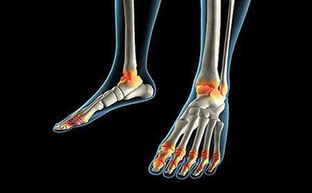 2 人 赞同了该文章 大量研究显示,20%有过踝关节反复扭伤史者会发生