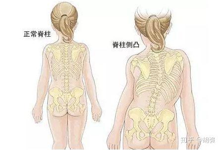 脊柱侧弯要不要继续运动