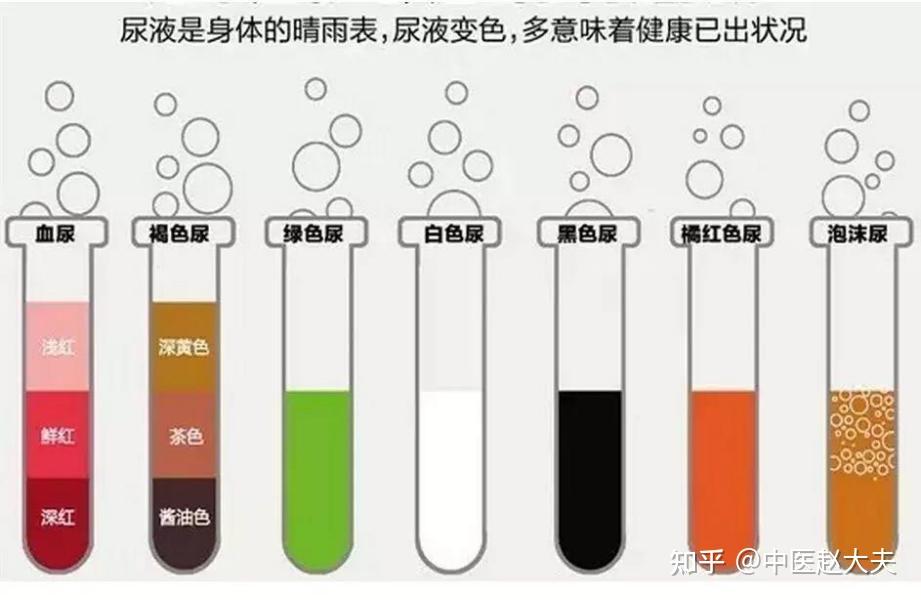 02白细胞正常尿液镜检白细胞不会超过5个,如有大量出现则要考虑尿路