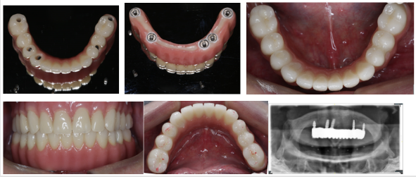 有种诺贝尔种植牙技术好的郑州医生推荐?