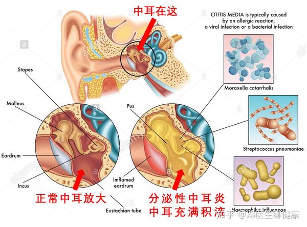 如果宝宝被诊断为"非化脓性中耳炎,渗出性中耳炎,卡他性中耳炎,浆液性