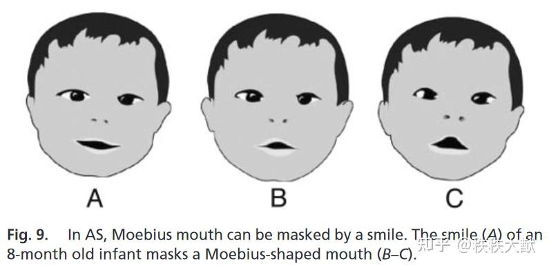 请问阿斯伯格综合征孩子的莫比乌斯嘴型是什么样子