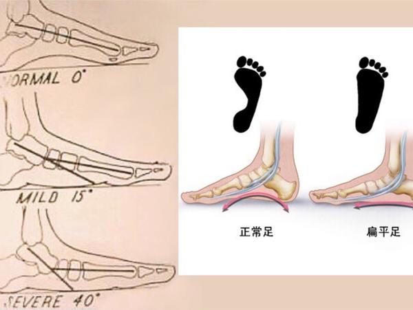 下期继续和大家聊一聊怎么去改变扁平足