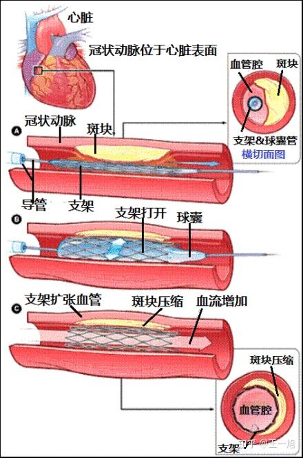 支架是目前开通被血栓闭堵的冠状动脉最优化的开通措施.