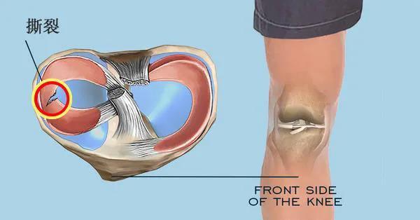 5个迹象提示半月板受伤了