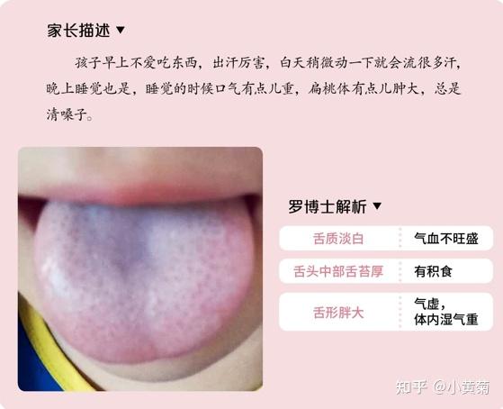 (2)脾阳虚和气虚可能同时出现这个孩子的舌苔铺满了整个舌头,这种现象