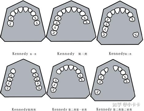 以下牙位缺失(以下数字为缺失牙位)按肯氏分类法进行分类 知乎