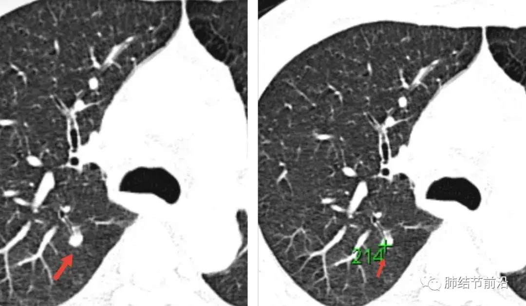 易误诊的肺部实性结节影像学特征大集合