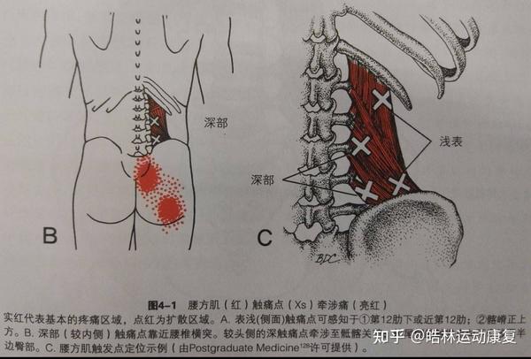 什么是腰背肌筋膜炎?