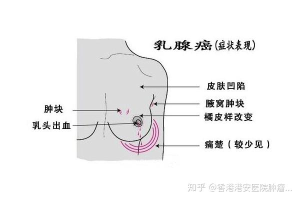 其实乳腺癌还是有症状可以发现,乳腺癌典型的症状有乳房有明显的肿块