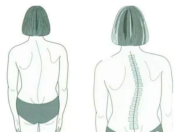 研究人员设计了新的成人特发性脊柱侧凸x线分型系统