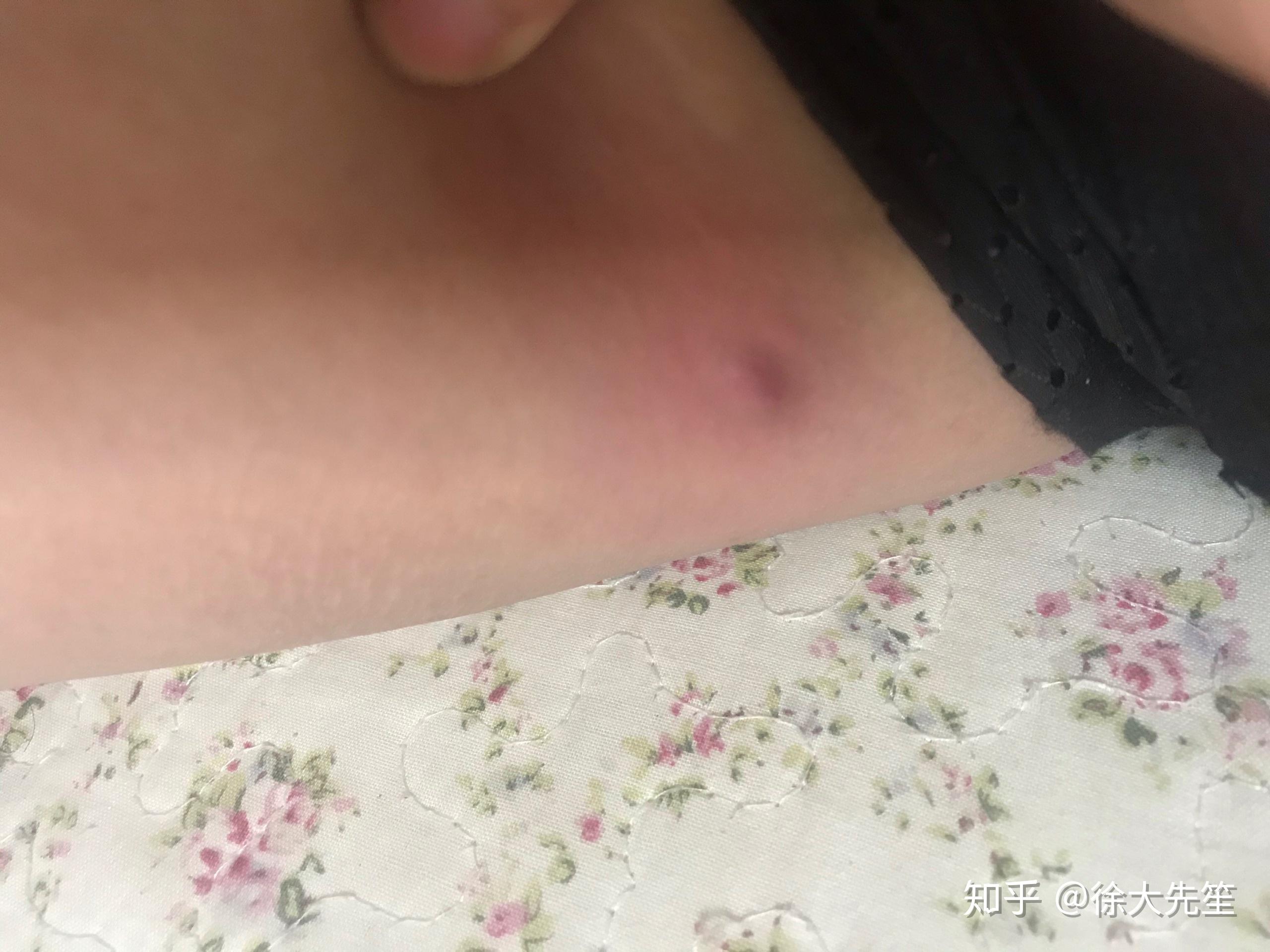 大腿根部长的肉疙瘩