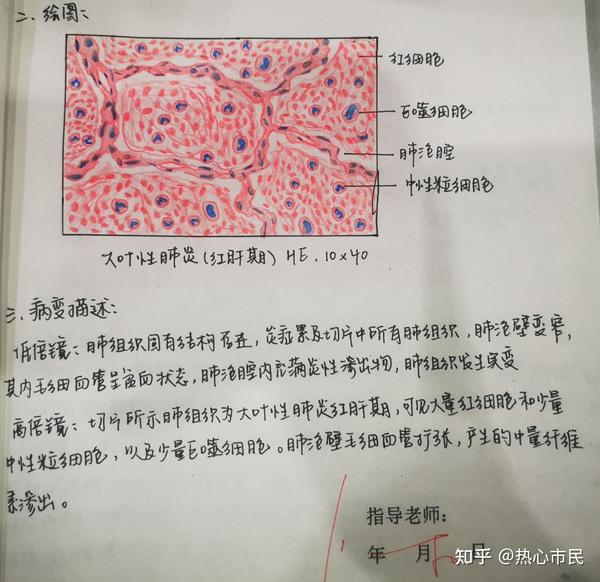 病理学红蓝铅笔手绘图 实验报告病变描述