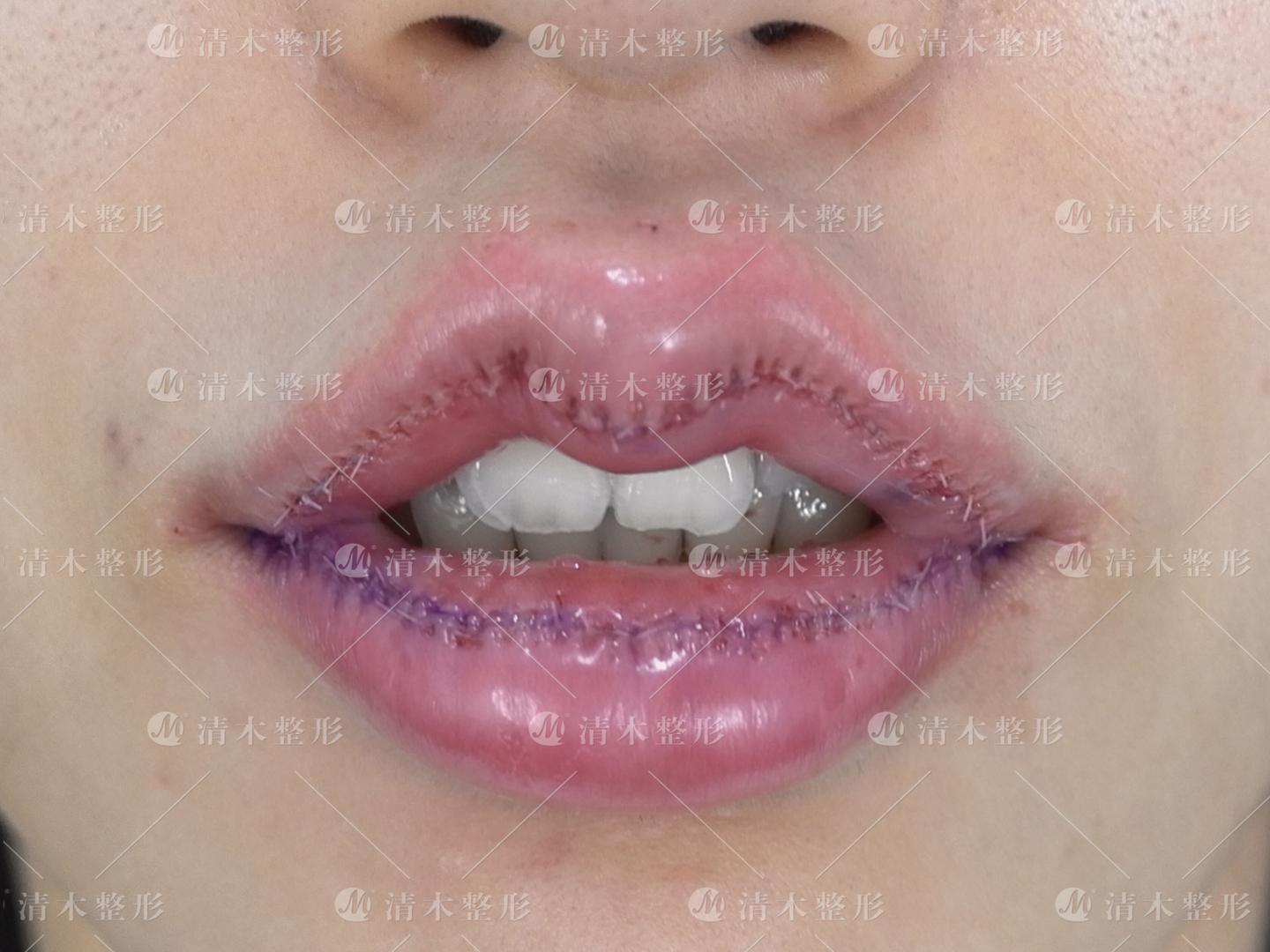 m唇手术一个月了嘴还硬的凸起是恢复慢还是疤痕增生?