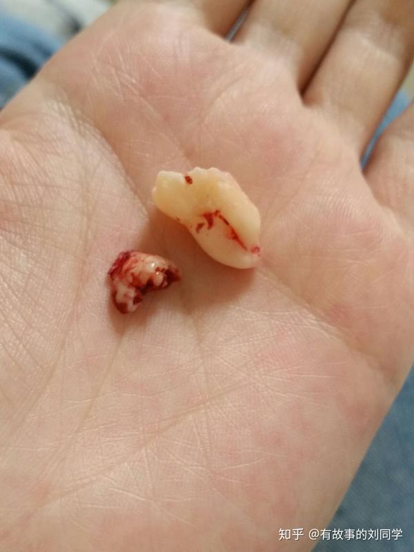 好的,恭喜刘总今日喜提一颗智齿,哈哈哈
