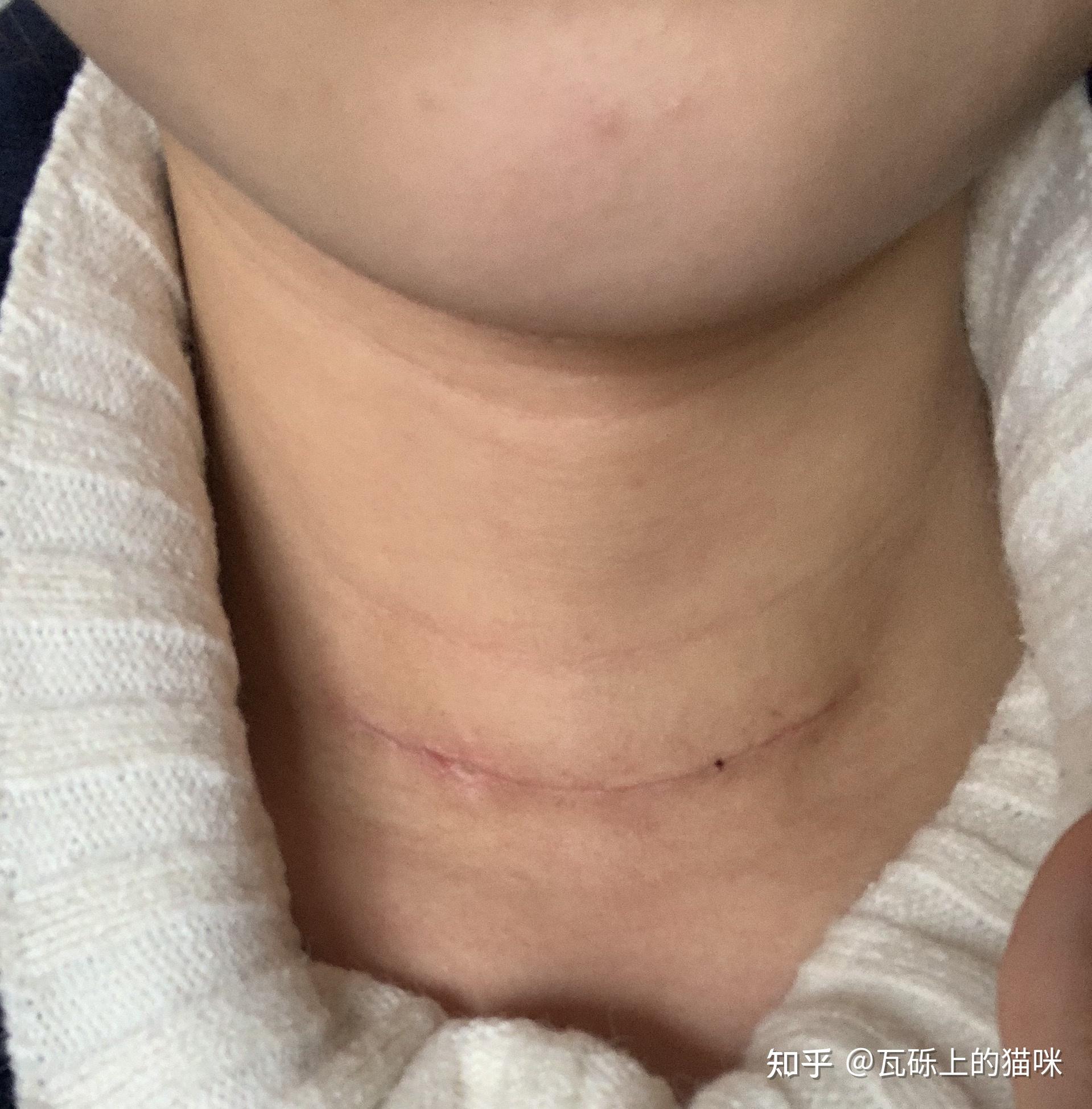女,26岁,甲状腺乳头状癌