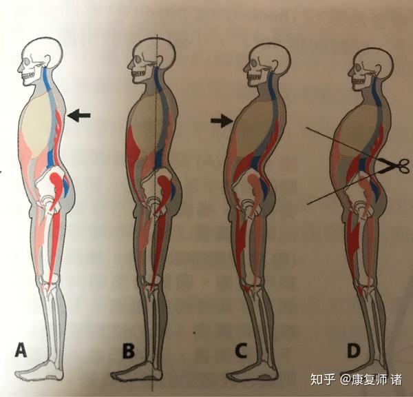 腰椎间盘突出可以自愈吗?