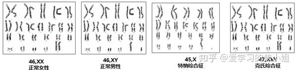 染色体数目异常核型表示:总则基础上 染色体编号,如:21三体:47