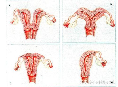子宫畸形,到底还有怀孕的机会吗?