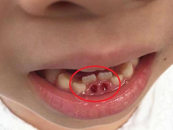 下牙往高扔上牙往低扔儿童换牙期护理需注意这5个方面