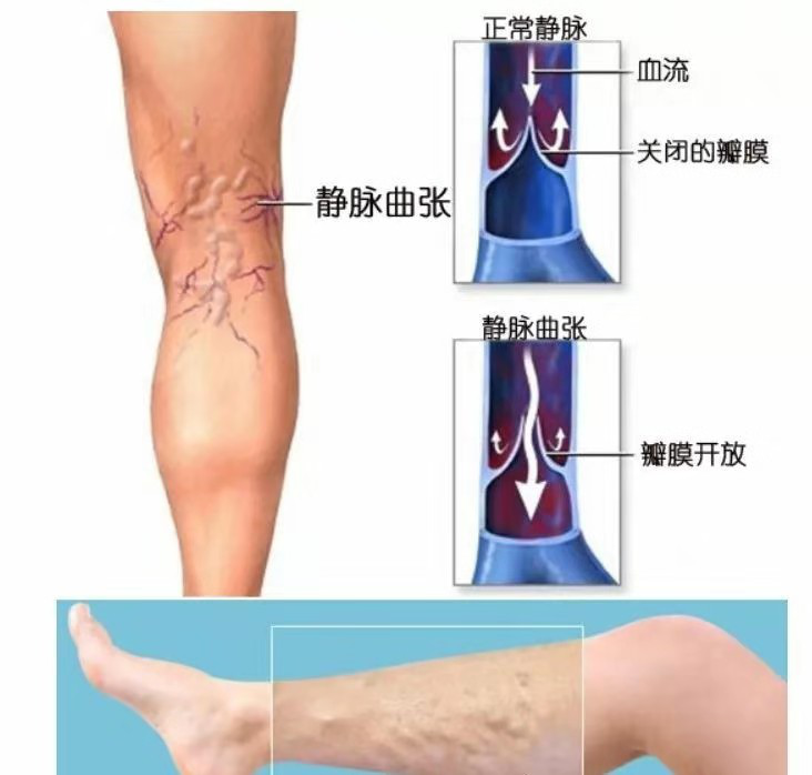 腿下段及踝部出现皮肤色素沉着,皮炎湿疹,和溃疡形成,还可因曲张静脉