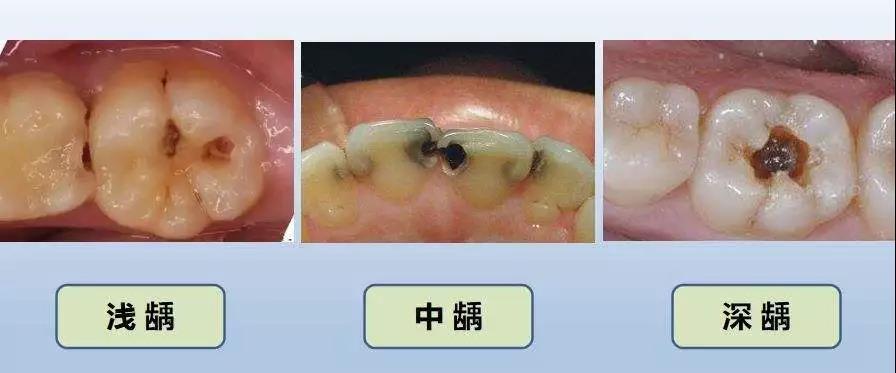 如果牙齿放任不管, 就会由原来的黑线发展为蛀洞, 严重的这口牙都要