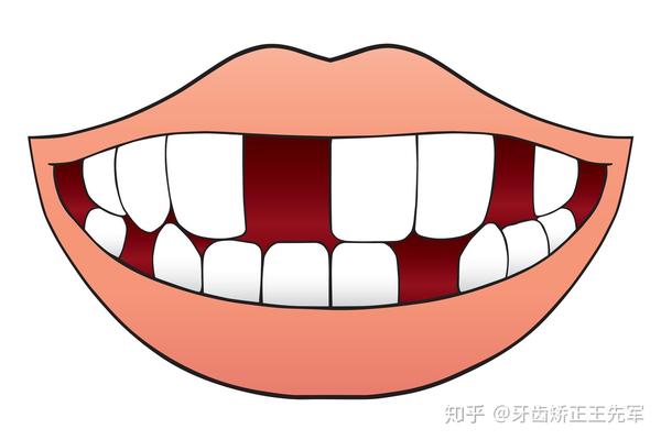 牙齿稀疏牙缝大怎么办呢?苏州牙齿矫正多少钱