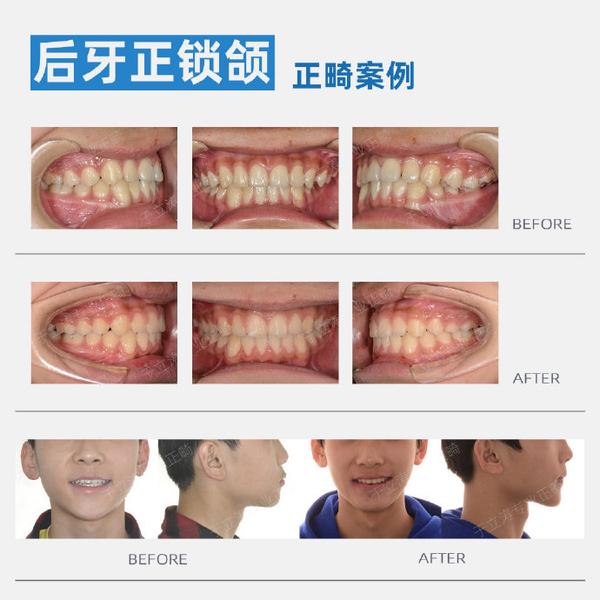 后牙正锁颌