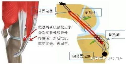 前叉韧带重建患者在家如何康复训练?