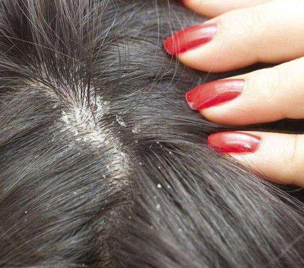 得了毛囊炎,头发还能再长吗?毛囊炎有哪些临床表现?