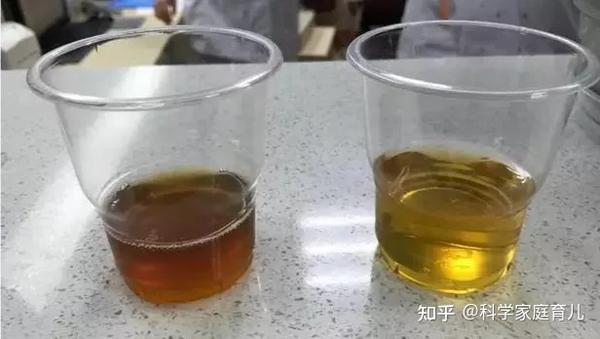 家庭育儿原创 蚕豆病发病时,最典型的表现是: 尿样呈酱油色或浓茶色