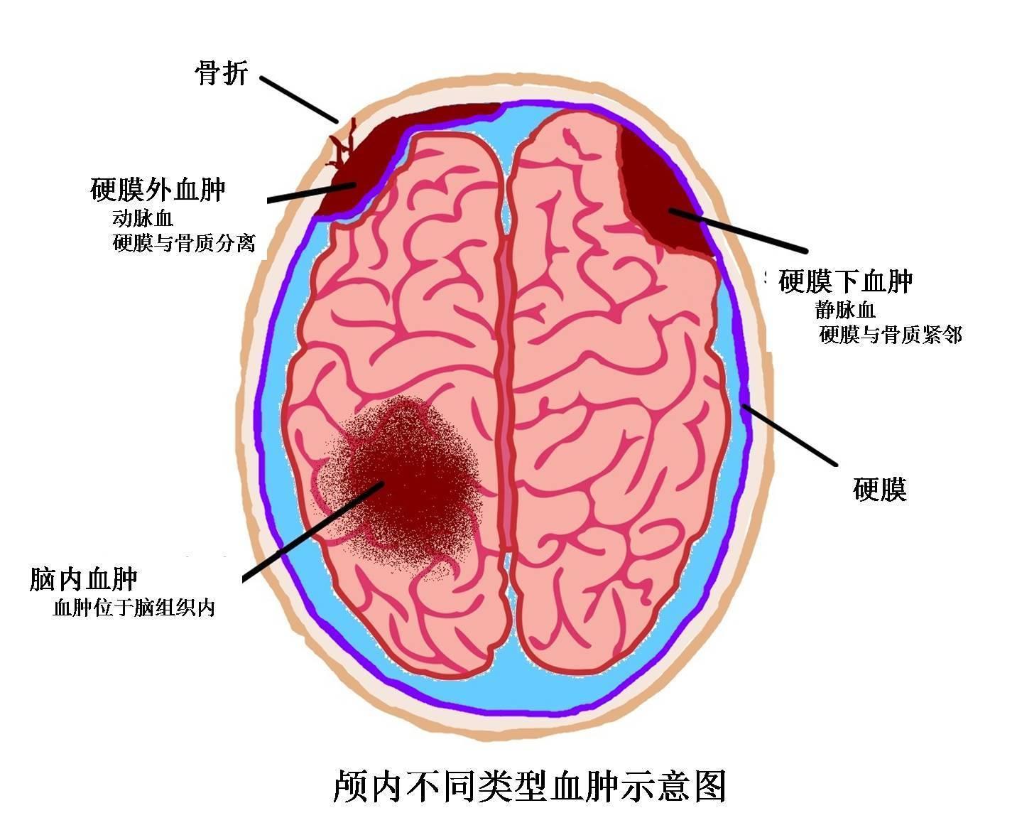 假如我颅内出血