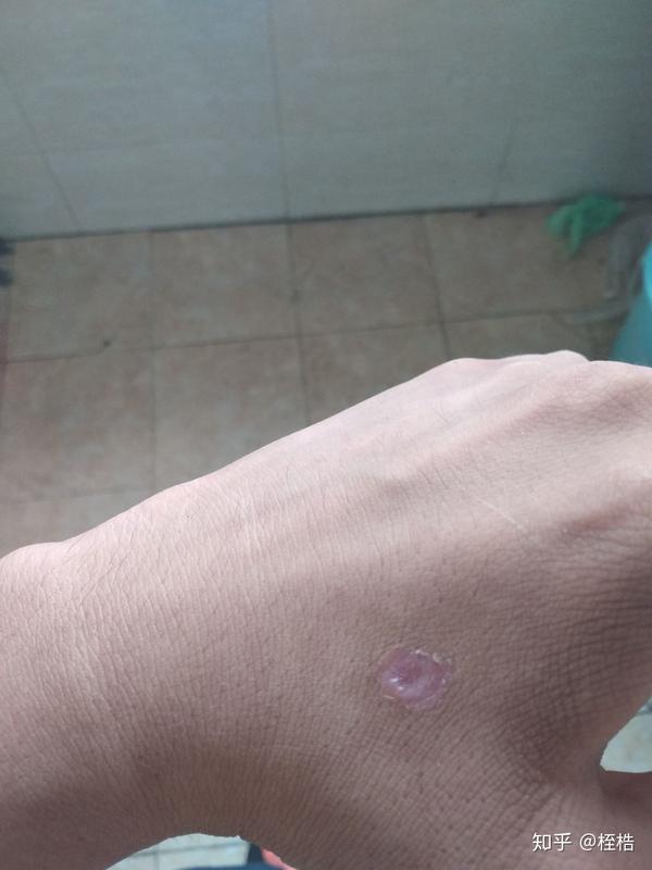烟头烫在身上是怎样的?