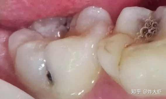 怎么有效保护牙齿,防止虫牙乳牙出现龋坏了要不要去看医生?为你解惑