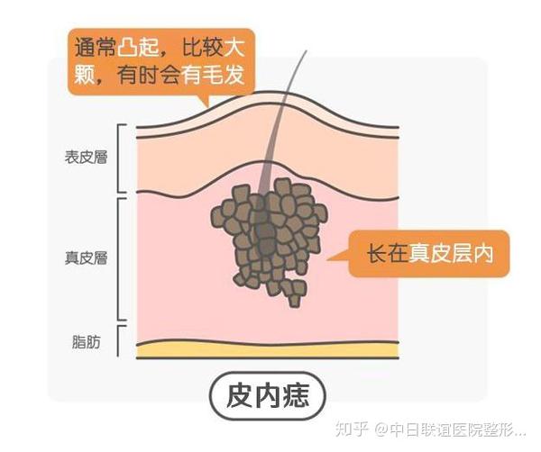 的色素痣都可以通过手术切除,浅表的色素痣可采用液氮冷冻和激光治疗