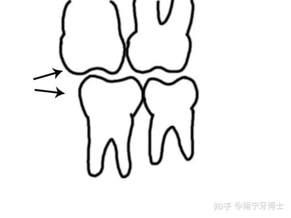 为什么口腔医生都喜欢拔智齿