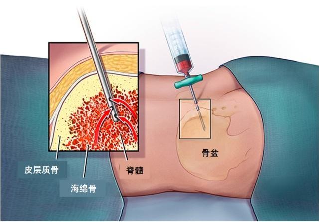 新型冠状病毒211骨髓穿刺失败原因绝对绝对骨髓活检