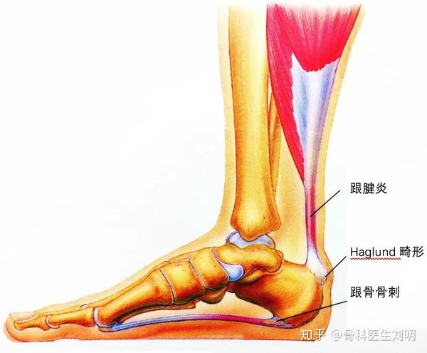 发生部位在跟腱的跟骨止点附近,很多被当做"跟腱炎"错误治疗; 1,足跟