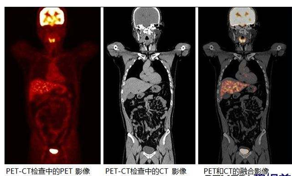 偷偷告诉你个笑话,用pet-ct做肿瘤早筛吧