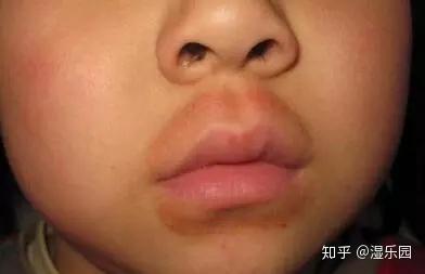 宝宝嘴巴周围红通通的一圈是湿疹吗