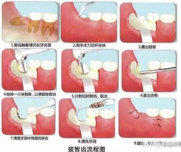 不同地方,不同拔牙方法,收费差异不同.