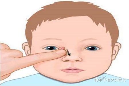 首大石萍:新生儿鼻泪管堵塞非常常见 大多会自行痊愈