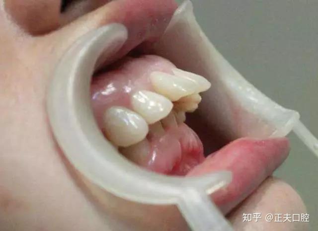 龅牙会遗传吗