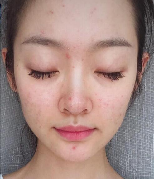 青春痘的问题实在是难以解决,不过在青春期这些祛痘方法真的好用