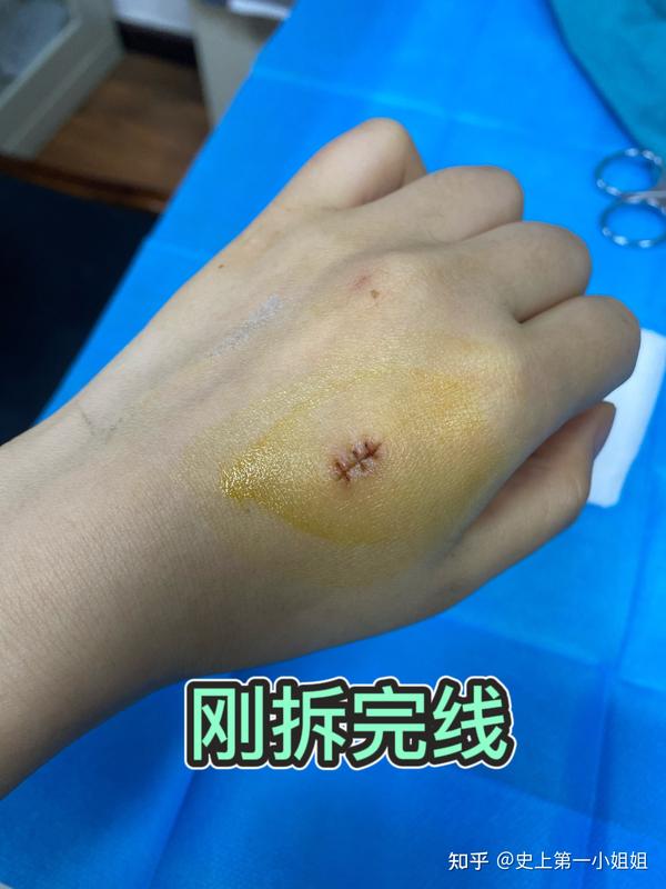 线缝得有点紧,拆线的时候不好拆,剪刀有剪到肉肉,有一点点出血,一点点