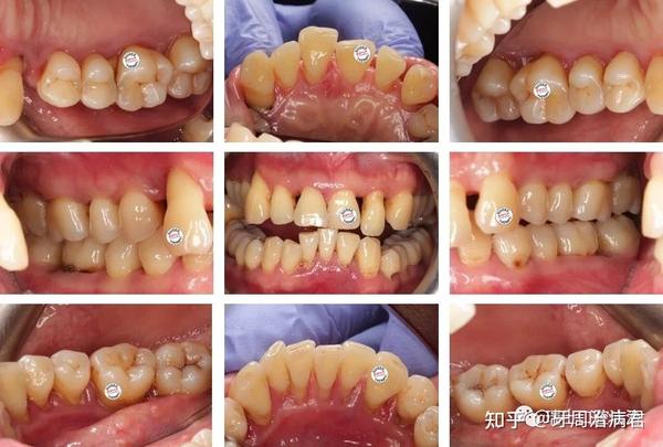 重度牙周炎的多学科治疗